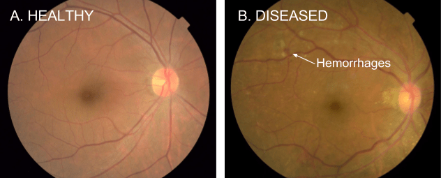 AI Technology Detecting Heart Disease 